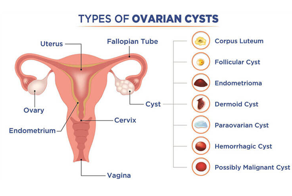Ovarian Cyst Management