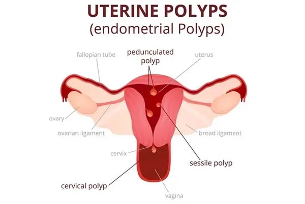 Polyp