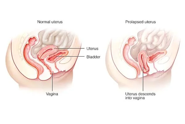 Uterine Prolapse