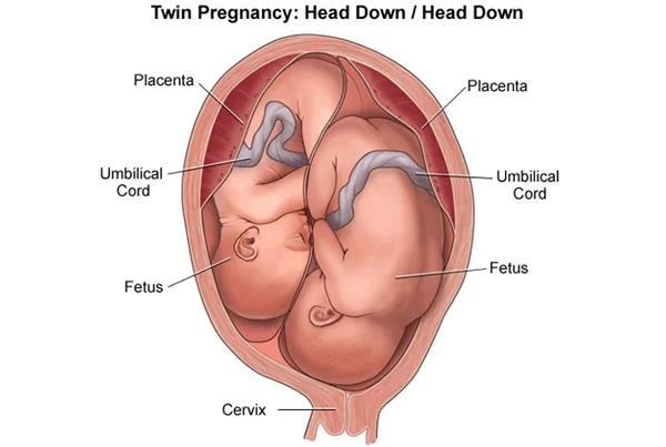 Multiple Pregnancy