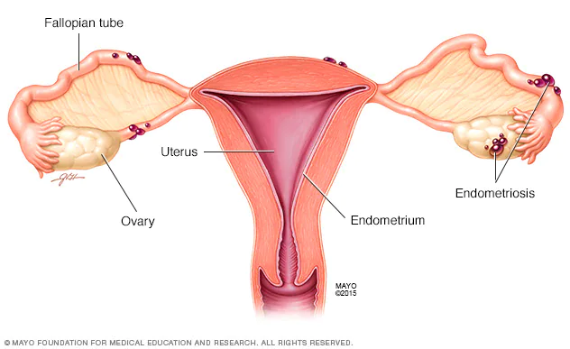Best Endometriosis Treatment