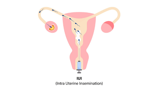 Intrauterine insemination treatment